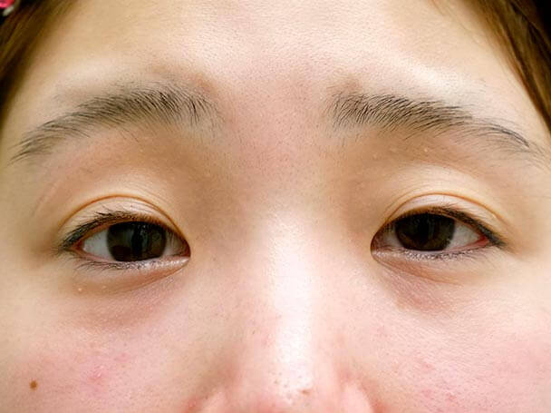症例1 術前